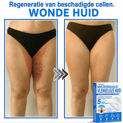 Officiële merkshop | 🎉 TopSpire® 2-in-1 Micro-naald & Hydrocolloïde Pleisters | Voor verheven moedervlekken, acne, platte wratten & huidaanhangsels