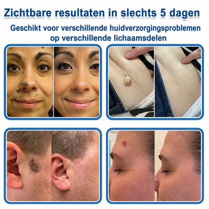 Officiële merkshop | 🎉 TopSpire® 2-in-1 Micro-naald & Hydrocolloïde Pleisters | Voor verheven moedervlekken, acne, platte wratten & huidaanhangsels