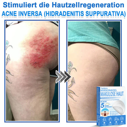 Officiële merkshop | 🎉 TopSpire® 2-in-1 Micro-naald & Hydrocolloïde Pleisters | Voor verheven moedervlekken, acne, platte wratten & huidaanhangsels
